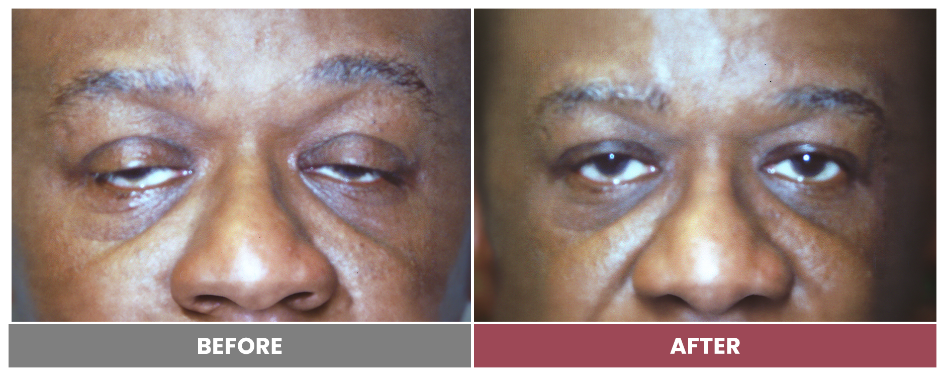 PTOSIS REPAIR - Case 67